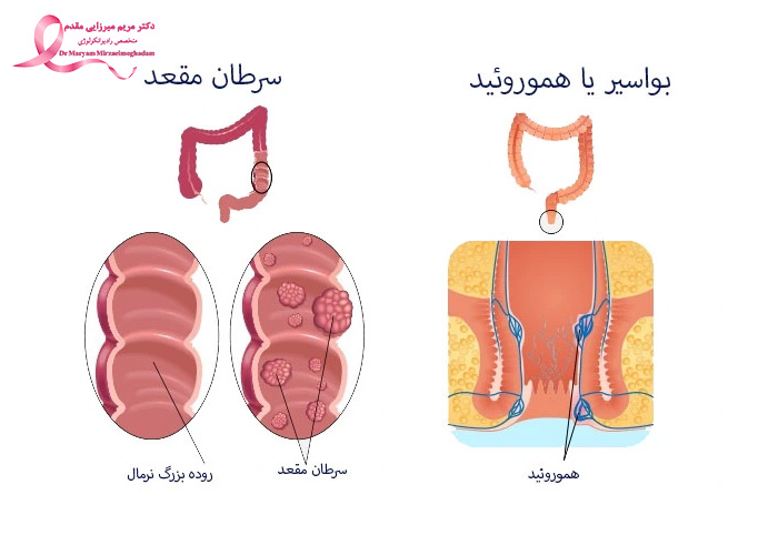 تفاوت کلی هموروئید (بواسیر) با سرطان روده