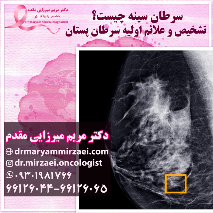 سرطان سینه چیست؟ تشخیص و علائم اولیه سرطان پستان دکتر میرزایی مقدم