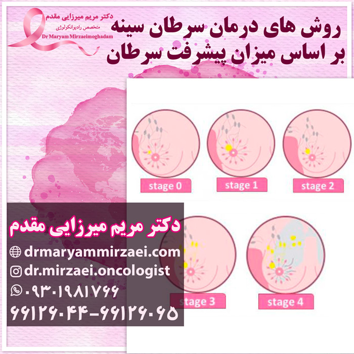 مراحل پیشرفت سرطان سینه