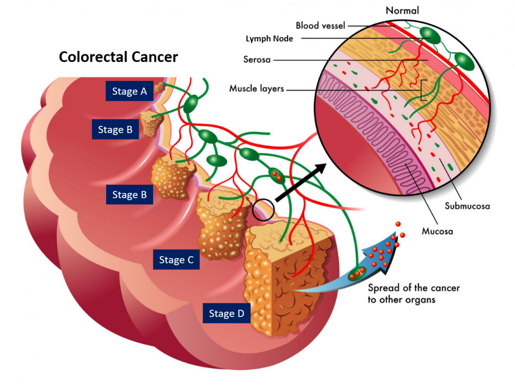 مراحل سرطان روده بزرگ