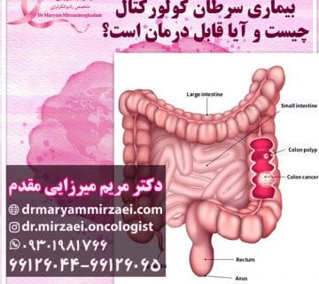 درمان سرطان کولورکتال
