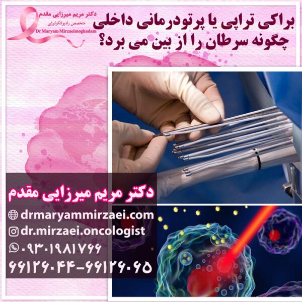 براکی تراپی یا پرتودرمانی داخلی