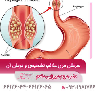 درمان سرطان مری