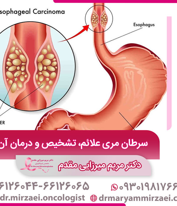 درمان سرطان مری