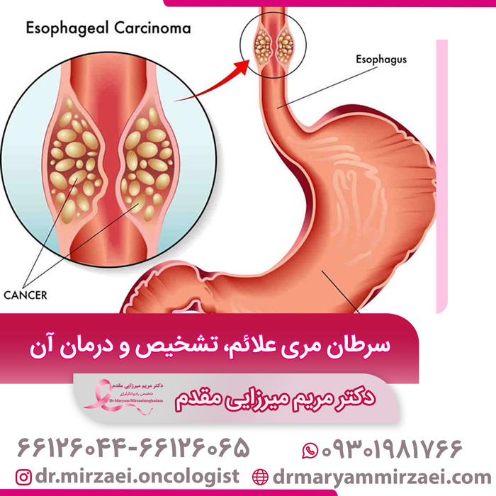 درمان سرطان مری