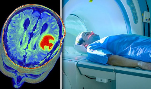 رادیوتراپی سرطان مغز