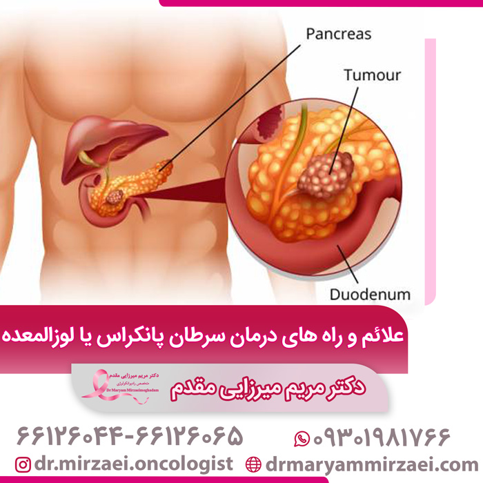 علائم و راه های درمان سرطان پانکراس یا لوزالمعده