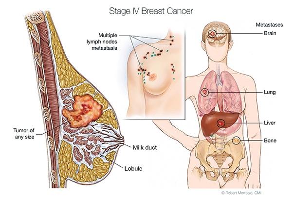 هورمون درمانی سرطان سینه