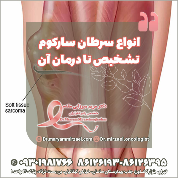 انواع سرطان سارکوم تشخیص تا درمان آن