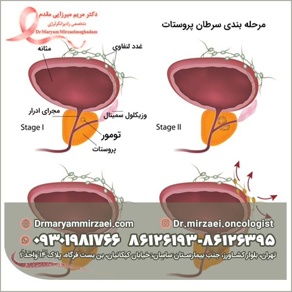 مراحل سرطان پروستات