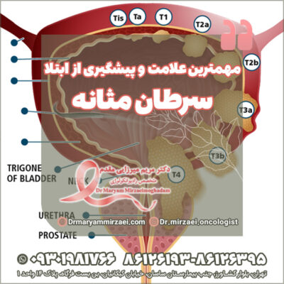 مهمترین علامت سرطان مثانه و پیشگیری از ابتلا مهمترین علامت سرطان مثانه و پیشگیری از ابتلا