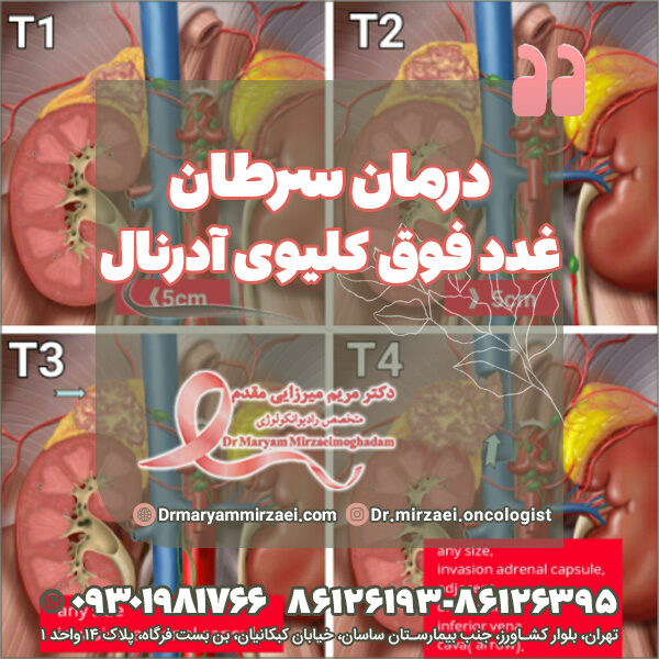 درمان سرطان غدد فوق کلیوی آدرنال توسط متخصص