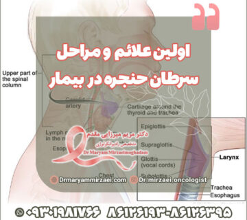 اولین علائم و مراحل سرطان حنجره در بیمار