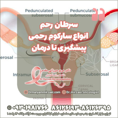 سرطان رحم و انواع سارکوم رحمی، پیشگیری تا درمان سرطان رحم و انواع سارکوم رحمی، پیشگیری تا درمان