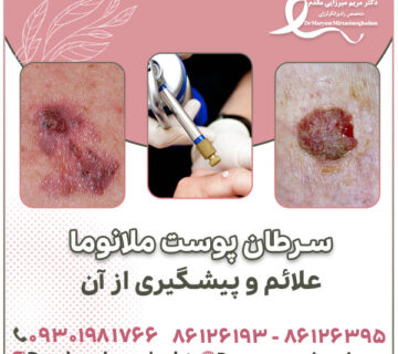 سرطان پوست ملانوما علائم و پیشگیری از آن