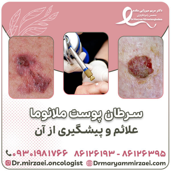 سرطان پوست ملانوما علائم و پیشگیری از آن