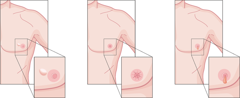 علائم سرطان سینه در مردان