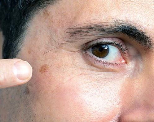 انواع سرطان پوست