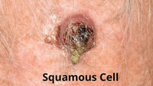 سرطان پوست سلول پایه