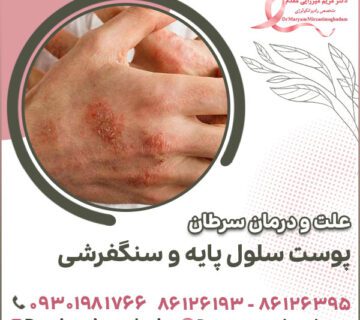 علت و درمان سرطان پوست سلول پایه و سنگفرشی