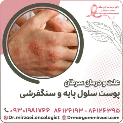علت و درمان سرطان پوست سلول پایه و سنگفرشی علت و درمان سرطان پوست سلول پایه و سنگفرشی