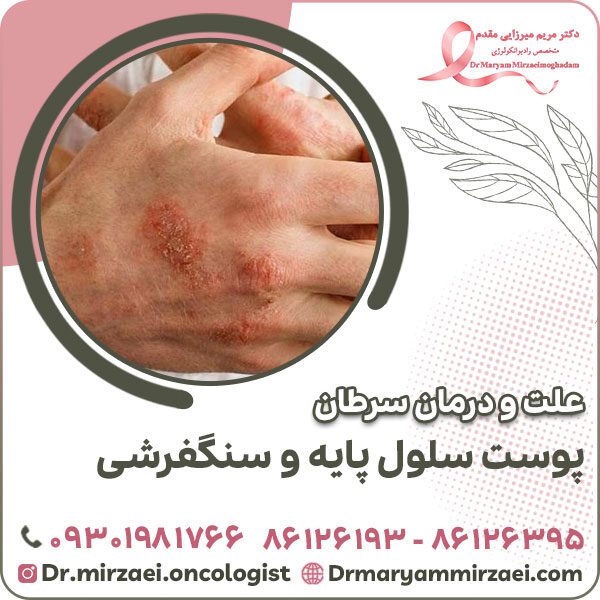 علت و درمان سرطان پوست سلول پایه و سنگفرشی