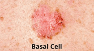 عکس سرطان پوست