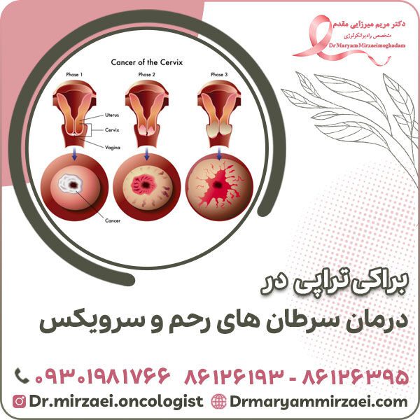 براکی تراپی در درمان سرطان های رحم و سرویکس