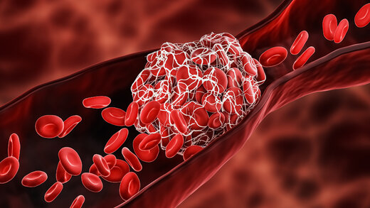 خونریزی شدید در هنگام مصرف داروی شیمی درمانی کادسیلا TDM1