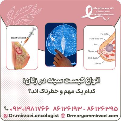 انواع کیست سینه در زنان؛ کدام یک مهم و خطرناک اند؟ انواع کیست سینه در زنان؛ کدام یک مهم و خطرناک اند؟