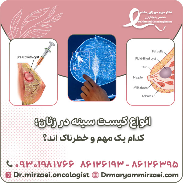 انواع کیست سینه در زنان؛ کدام یک مهم و خطرناک اند؟
