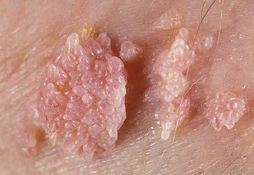 ویروس HPV و زگیل تناسلی