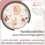 مرحله بندی سرطان سینه و تصاویر مربوط به هر مرحله از بیماری