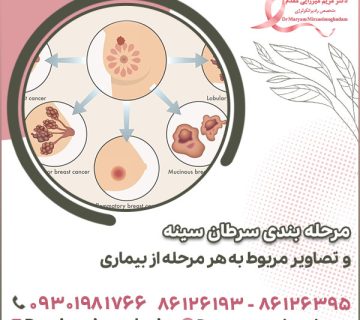 مرحله بندی سرطان سینه و تصاویر مربوط به هر مرحله از بیماری