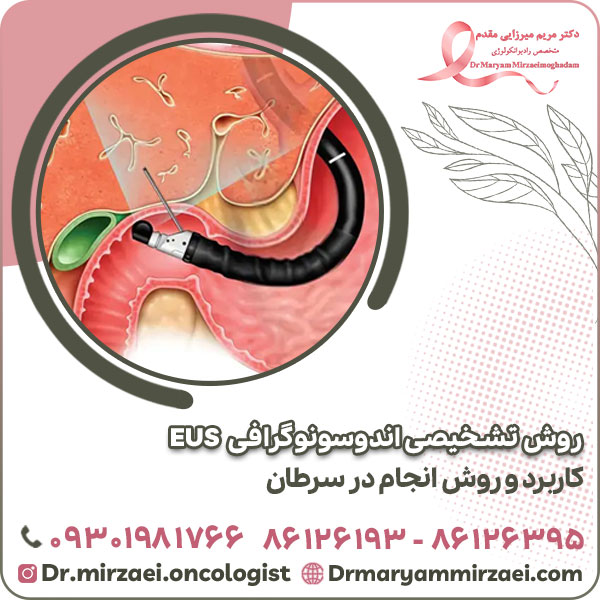 روش تشخیصی اندوسونوگرافی EUS کاربرد و روش انجام در سرطان