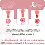 مرحله بندی سرطان دهانه رحم + تصاویر مراحل بیماری