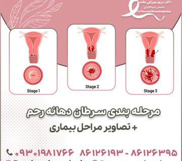 مرحله بندی سرطان دهانه رحم + تصاویر مراحل بیماری