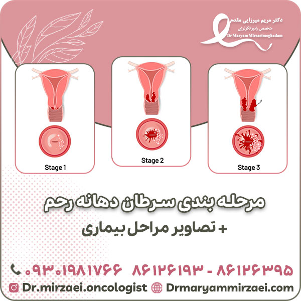 مرحله بندی سرطان دهانه رحم + تصاویر مراحل بیماری