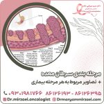 مرحله بندی سرطان معده؛ تصاویر مربوط به هر مرحله بیماری