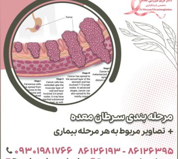 مرحله بندی سرطان معده؛ تصاویر مربوط به هر مرحله بیماری