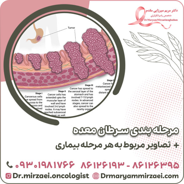مرحله بندی سرطان معده؛ تصاویر مربوط به هر مرحله بیماری