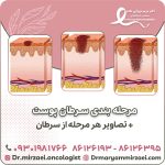 مرحله بندی سرطان پوست و تصاویر هر مرحله از سرطان