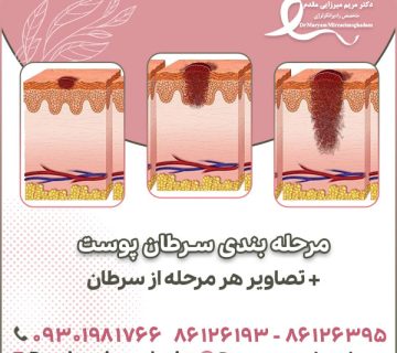 مرحله بندی سرطان پوست و تصاویر هر مرحله از سرطان