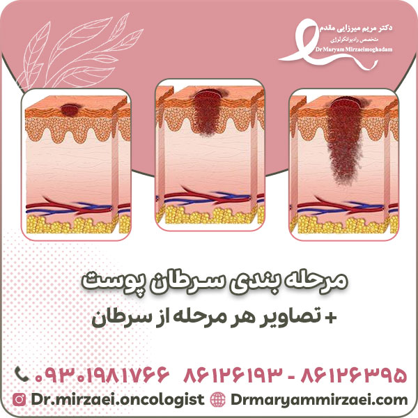 مرحله بندی سرطان پوست و تصاویر هر مرحله از سرطان