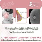 پاپیلوم داخل مجرای پستان چیست؟ یک توده خوش‌ خیم یا سرطانی؟