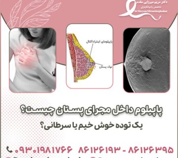 پاپیلوم داخل مجرای پستان چیست؟ یک توده خوش‌ خیم یا سرطانی؟