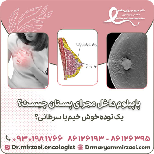 پاپیلوم داخل مجرای پستان چیست؟ یک توده خوش‌ خیم یا سرطانی؟
