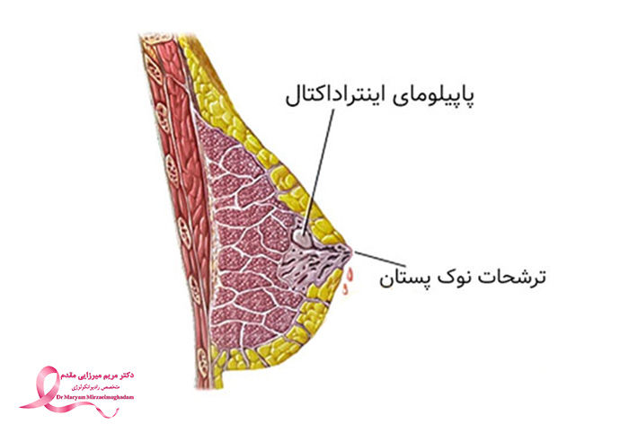 پاپیلوم داخل مجرای پستان