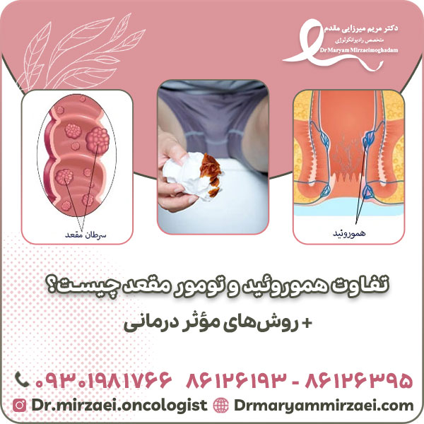 تفاوت هموروئید و تومور مقعد چیست؟ + روش‌های مؤثر درمانی